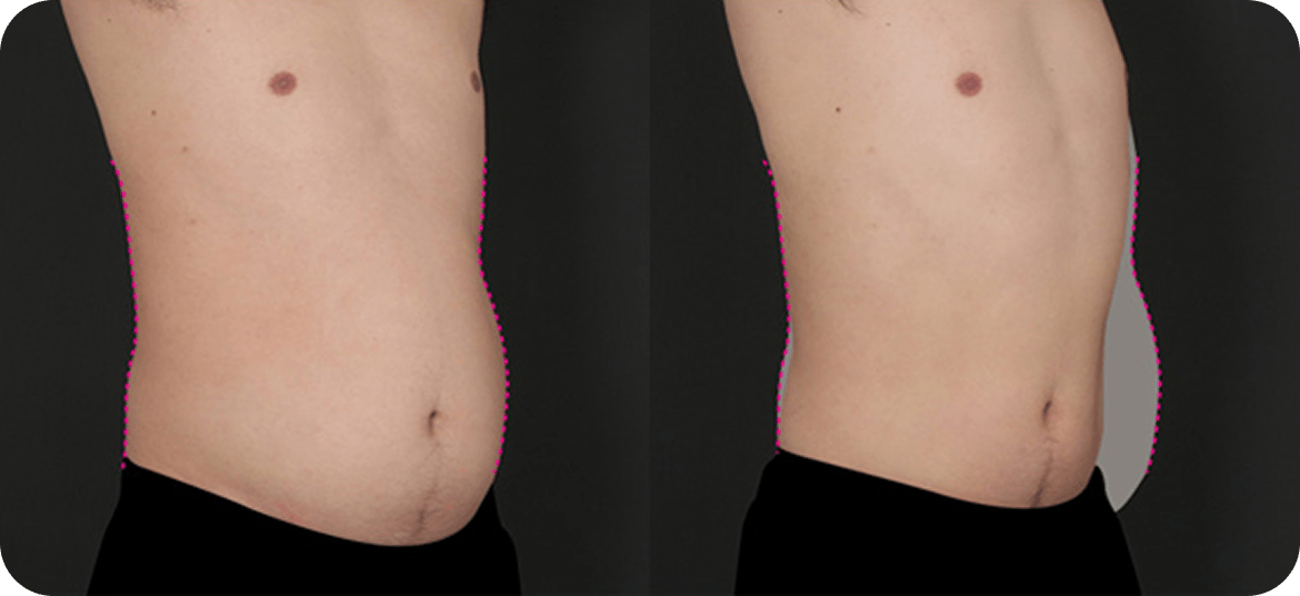 id Hospital - Male Abdominal Surgery - Before After Case 1