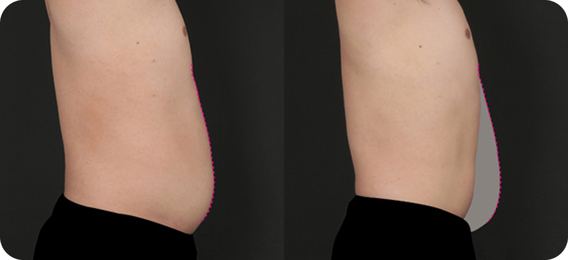 id Hospital - Male Abdominal Surgery - Before After Case 2