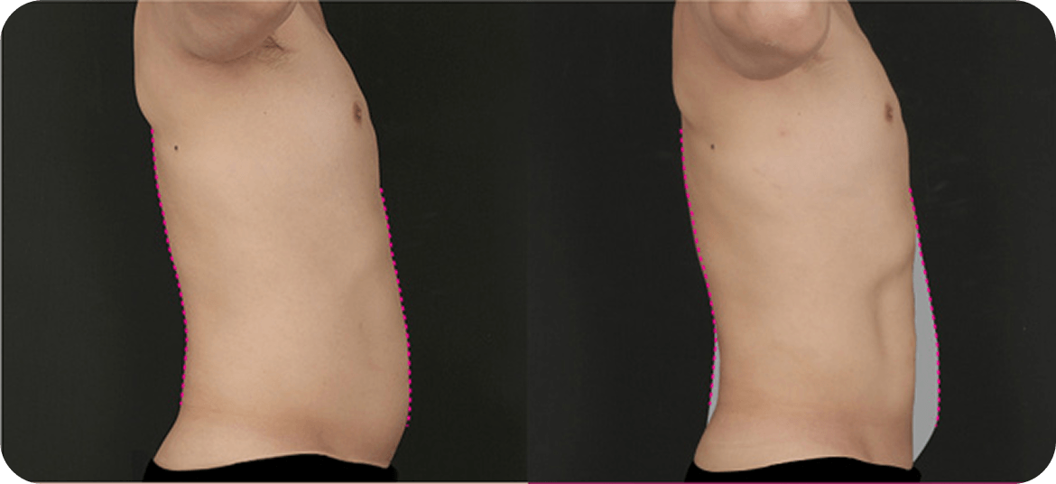 id Hospital - Male Abdominal Surgery - Before After Case 3
