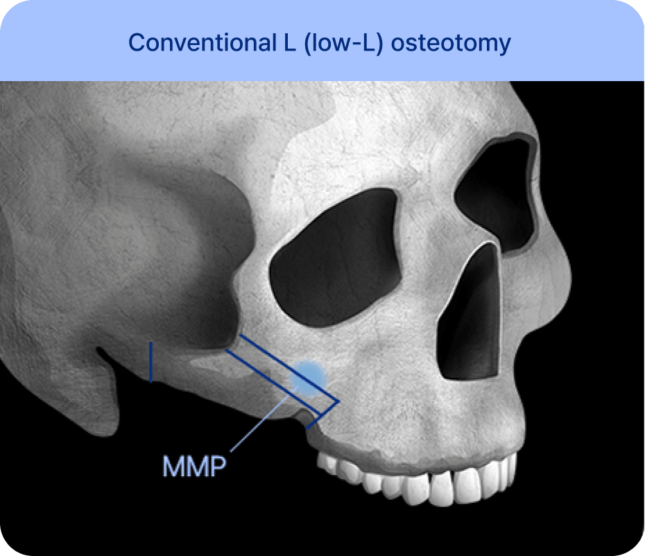 id Hospital - Male Facial Contouring - Conventional L (low-L) Osteotomy