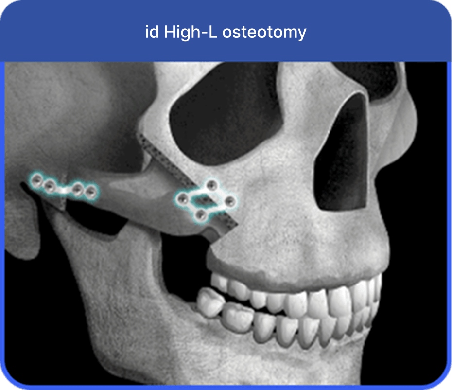id Hospital - Male Facial Contouring - id High-L Osteotomy
