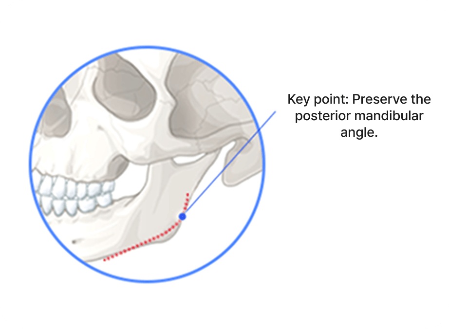 id Hospital - Male Facial Contouring - Only the Necessary Amount Resected