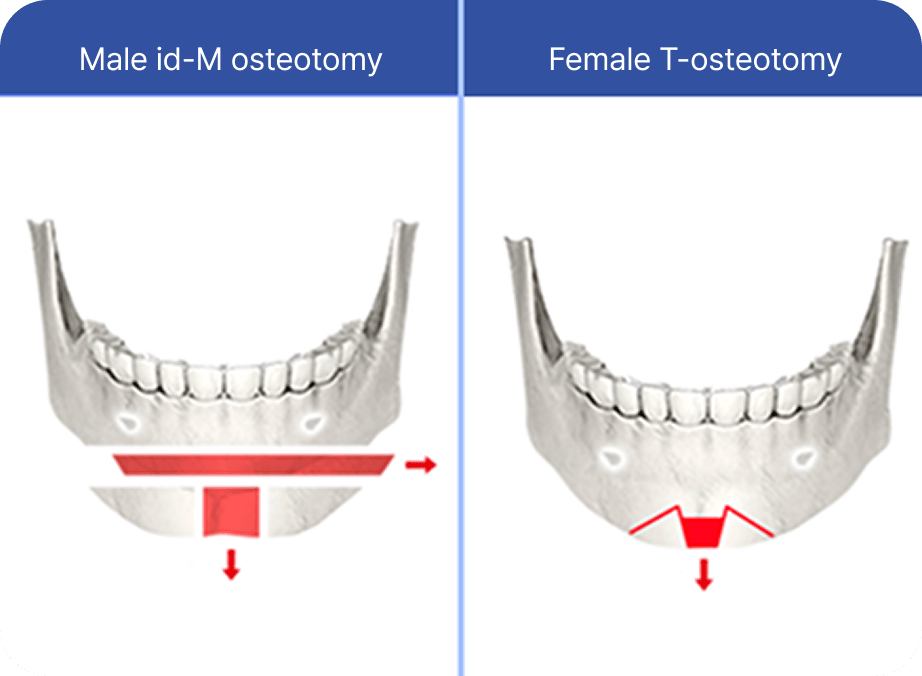 id Hospital - Male Facial Contouring - id-M Osteotomy Method