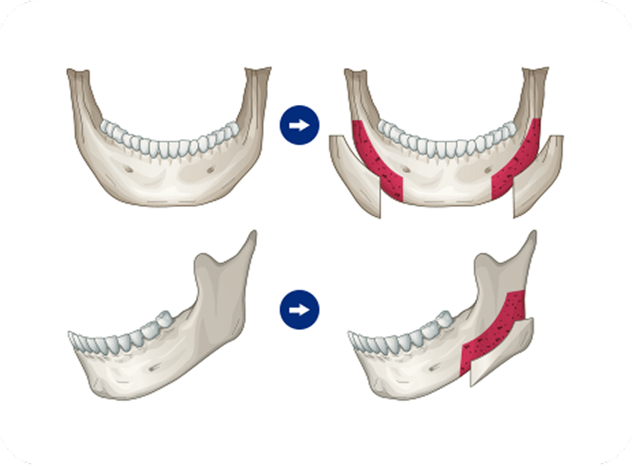 id Hospital - Male Facial Contouring - Cortical Bone Resection