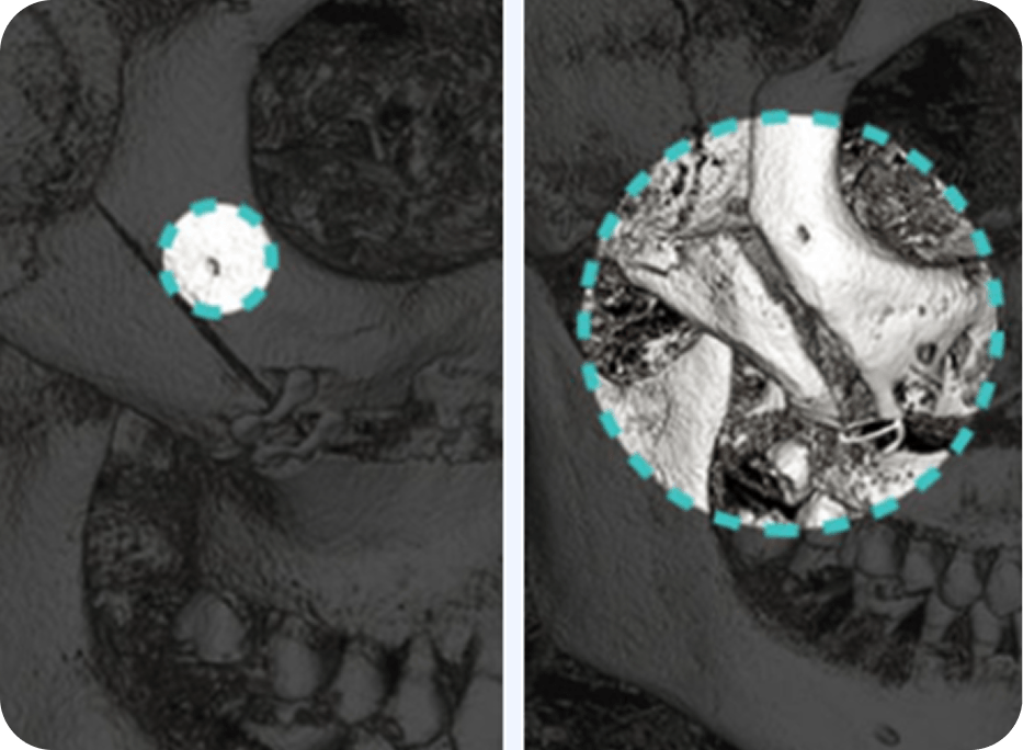 id Hospital - Male Facial Contouring - Minimized-Damage Resection