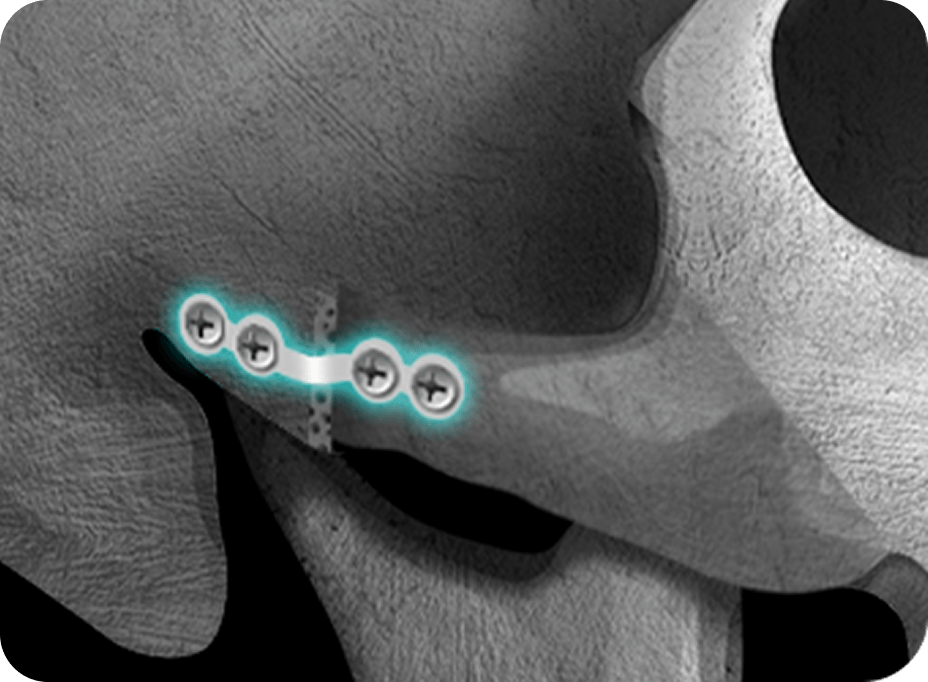id Hospital - Male Facial Contouring - Double Fixation with Titanium Material