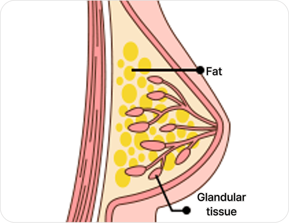id Hospital - Gynecomastia Surgery - Mixed Type