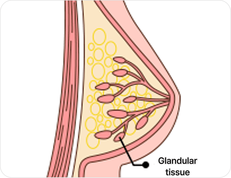 id Hospital - Gynecomastia Surgery - Glandular Removal Type