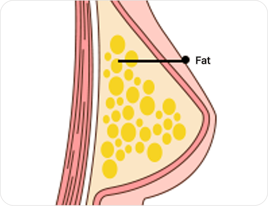id Hospital - Gynecomastia Surgery - Liposuction Type