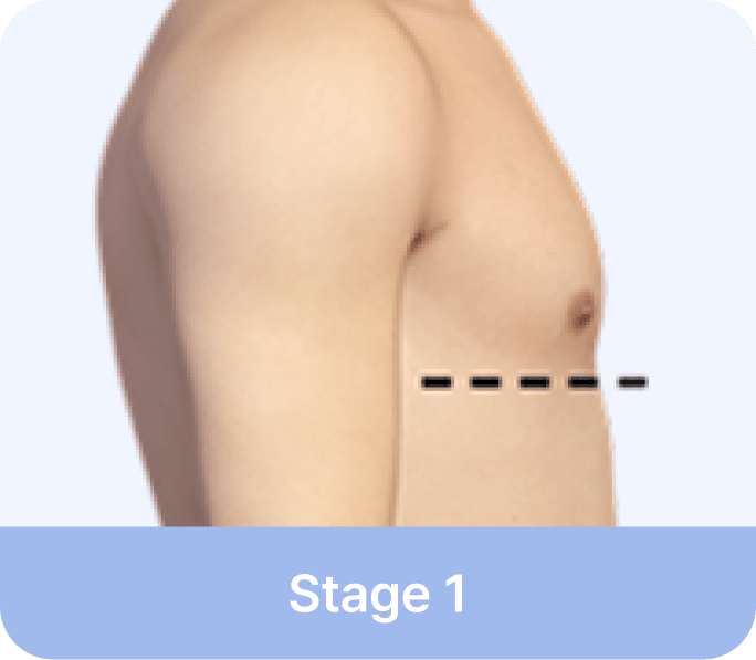 id Hospital - Gynecomastia Surgery - Stage 1