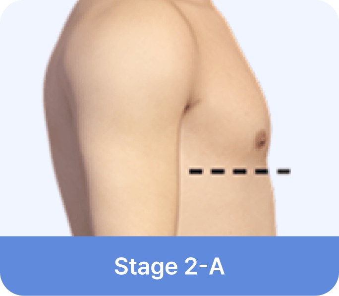 id Hospital - Gynecomastia Surgery - Stage 2-A