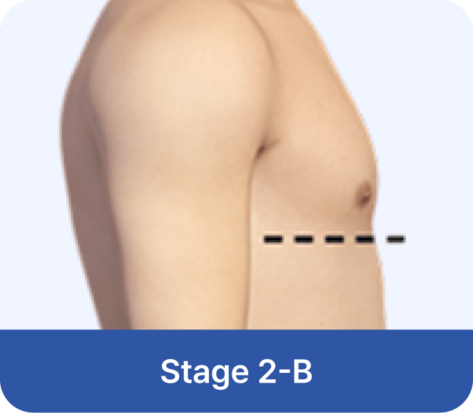 id Hospital - Gynecomastia Surgery - Stage 2-B