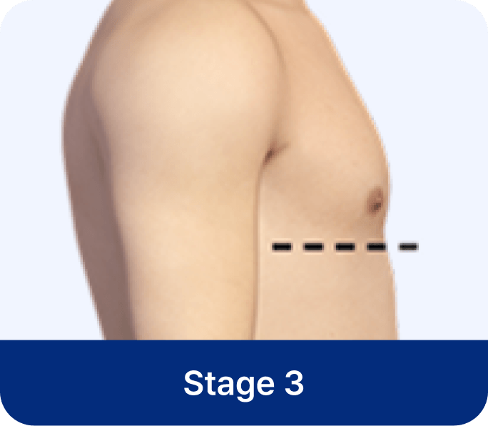 id Hospital - Gynecomastia Surgery - Stage 3