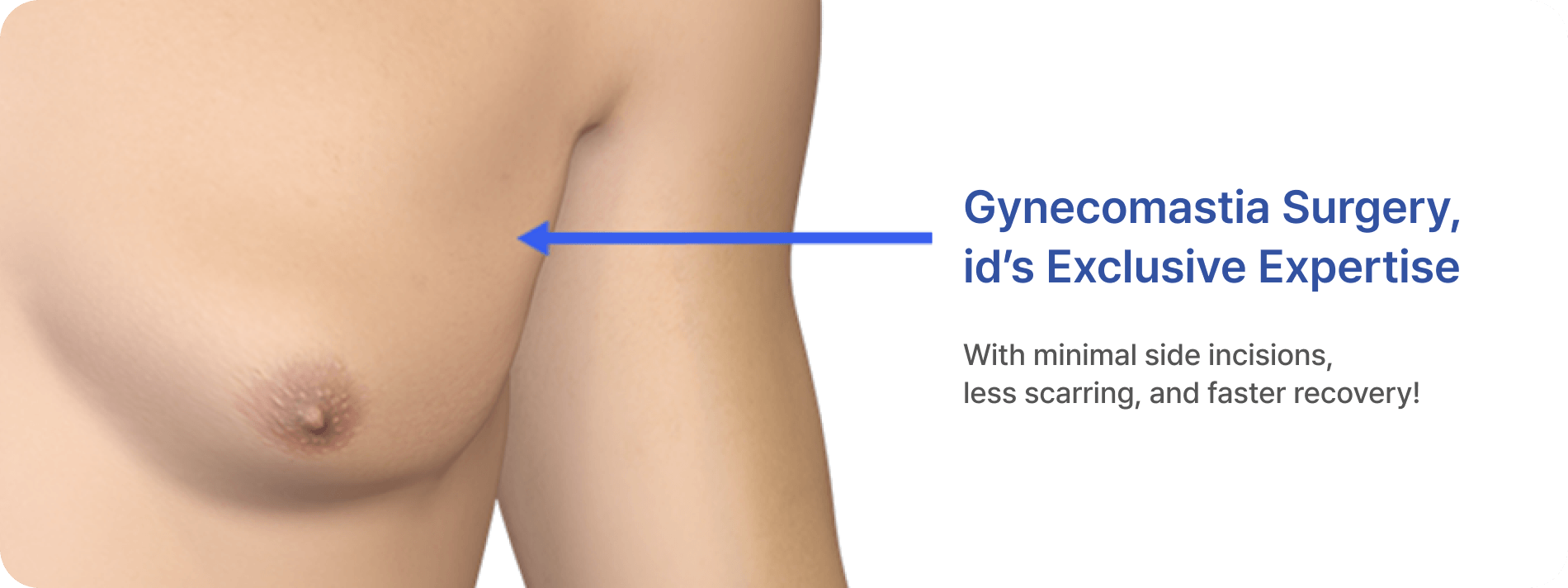 id Hospital - Gynecomastia Surgery - Numbness Prevention Side Incision