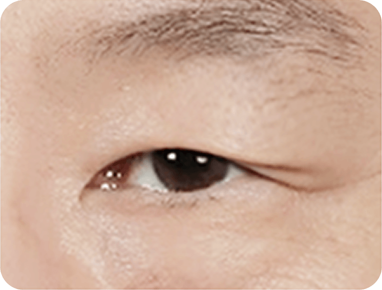 id Hospital - Male Mid-Age Eye Surgery - Upper Blepharoplasty STEP 1