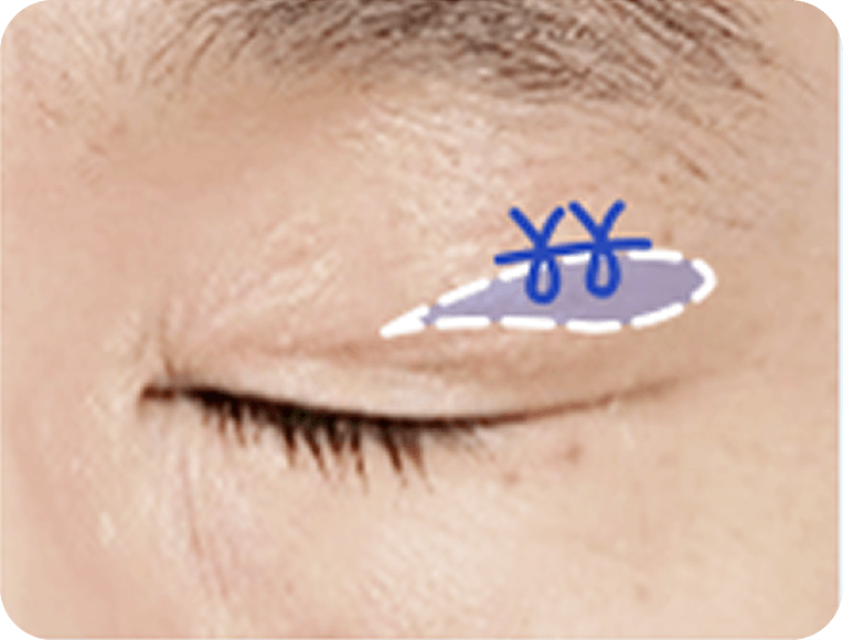 id Hospital - Male Mid-Age Eye Surgery - Upper Blepharoplasty STEP 2