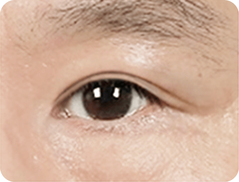 id Hospital - Male Mid-Age Eye Surgery - Upper Blepharoplasty STEP 3