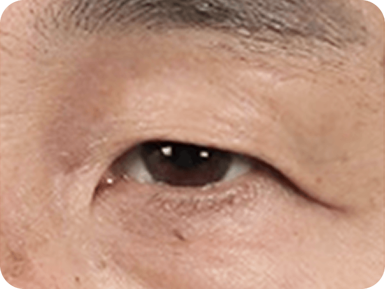 id Hospital - Male Mid-Age Eye Surgery - Brow Lift STEP 1