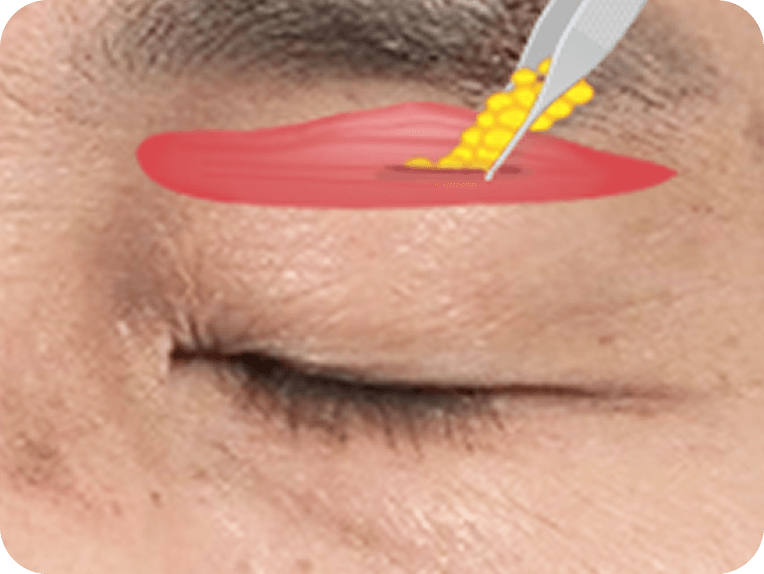 id Hospital - Male Mid-Age Eye Surgery - Brow Lift STEP 2