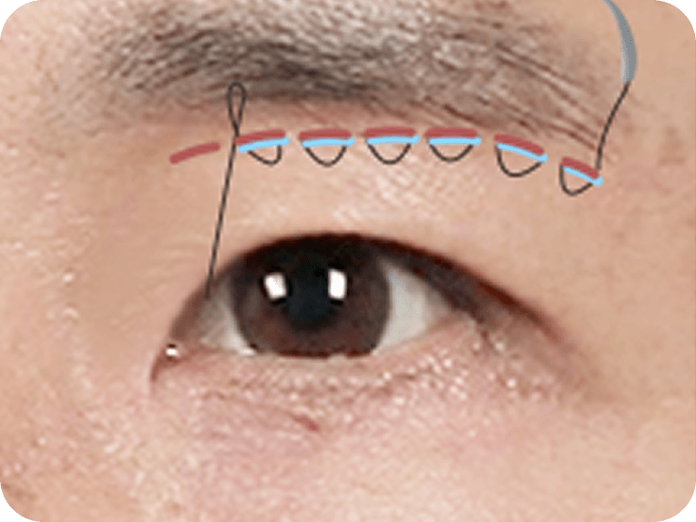 id Hospital - Male Mid-Age Eye Surgery - Brow Lift STEP 3