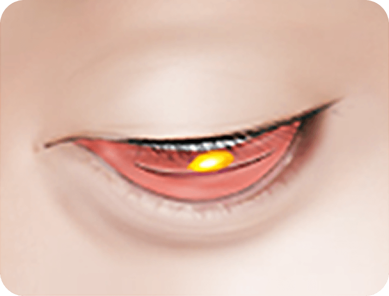 id Hospital - Male Mid-Age Eye Surgery - Lower Blepharoplasty STEP 1