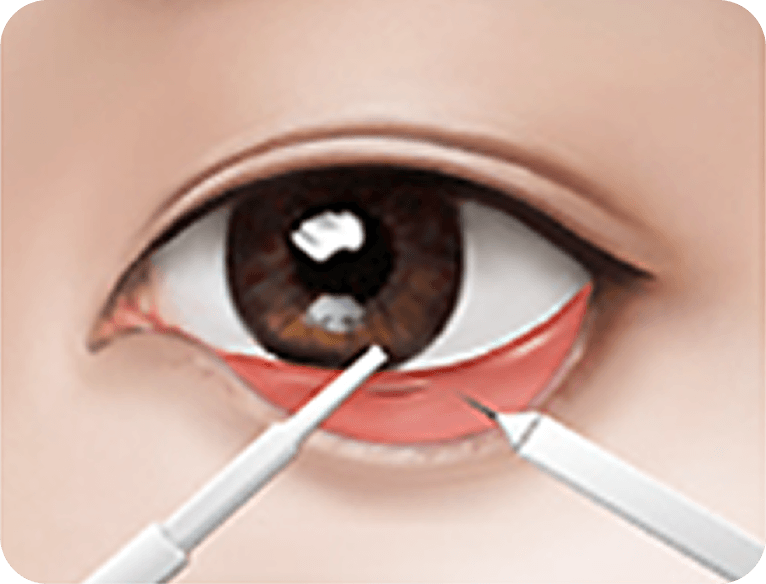 id Hospital - Male Mid-Age Eye Surgery - Lower Blepharoplasty STEP 2