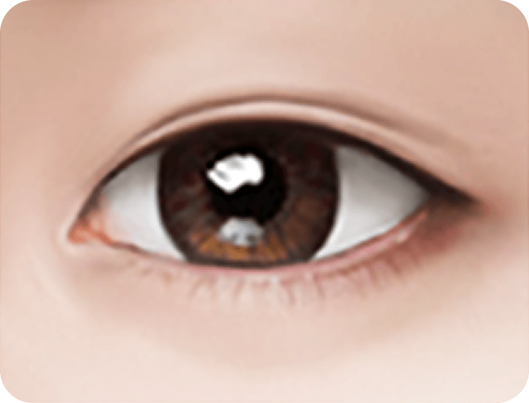 id Hospital - Male Mid-Age Eye Surgery - Lower Blepharoplasty STEP 3