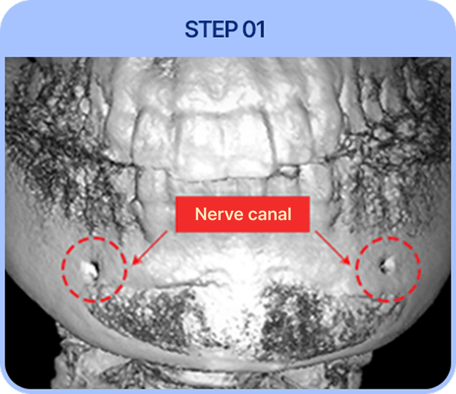id Hospital - Male Orthognathic Surgery - 3D-CT Scan Nerve Pathway