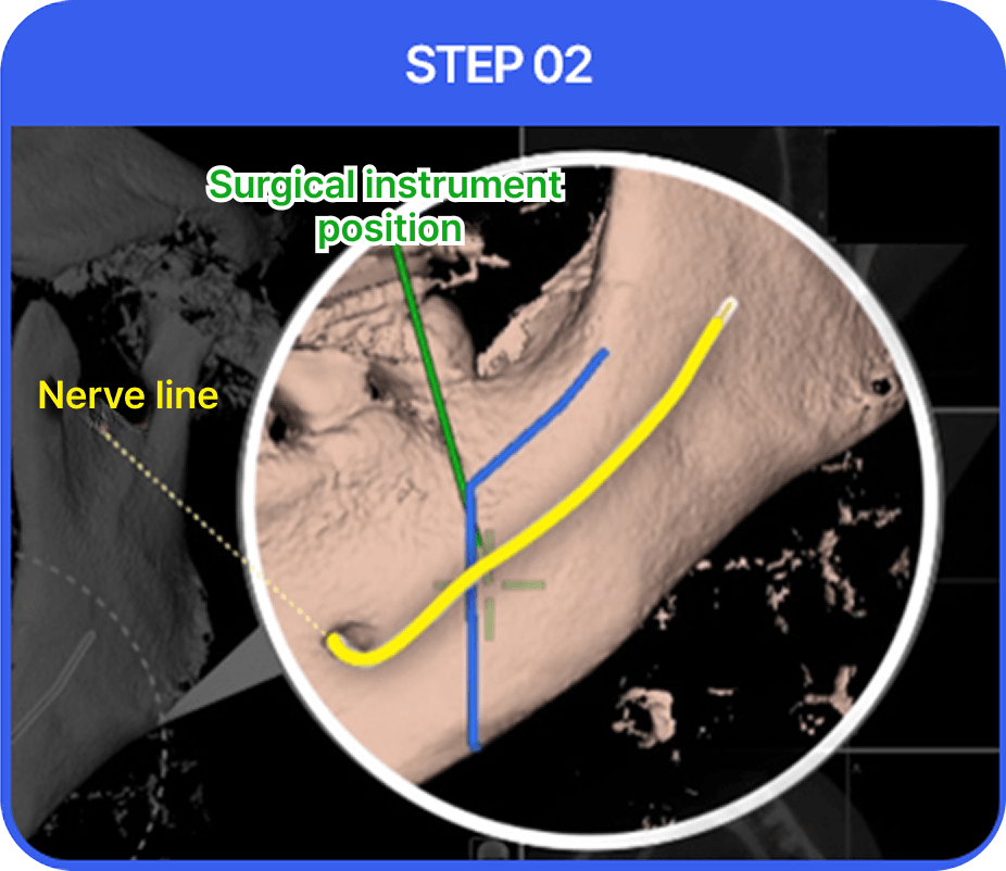 id Hospital - Male Orthognathic Surgery - Real-time Surgical Monitoring