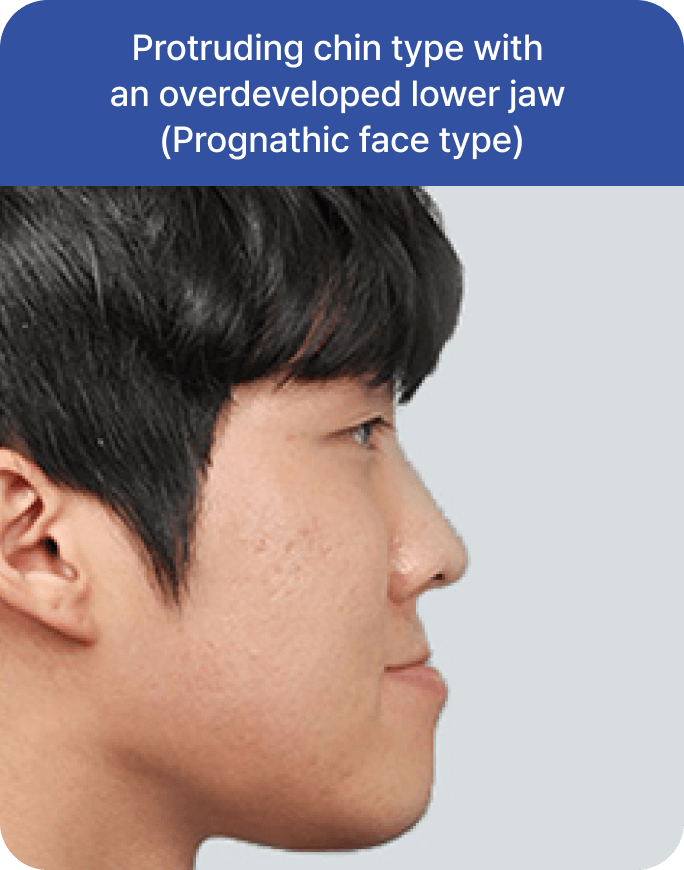 id Hospital - Male Orthognathic Surgery - Candidate Type 1