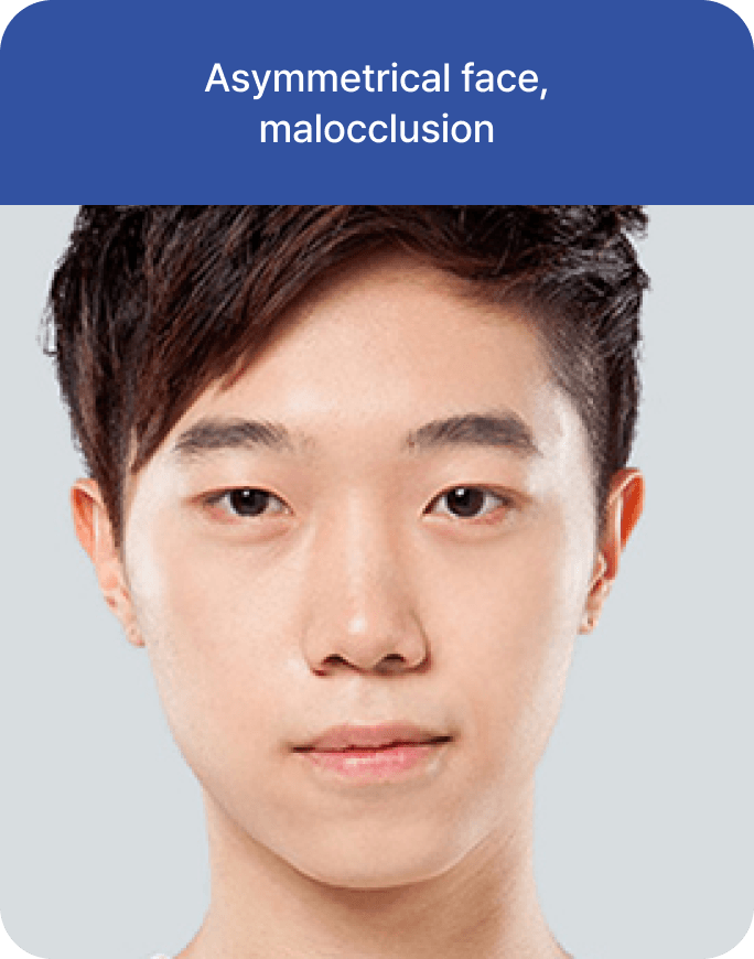id Hospital - Male Orthognathic Surgery - Candidate Type 3