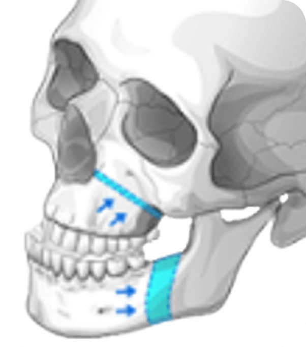 id Hospital - Male Orthognathic Surgery - Surgery Planned with 3D Simulation