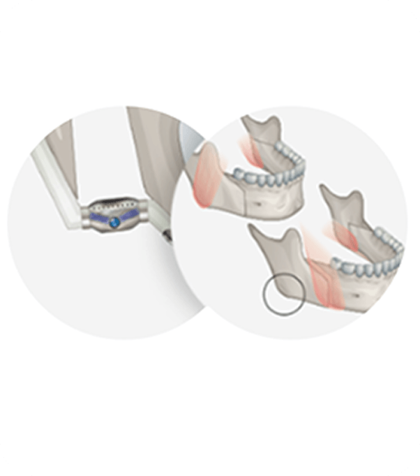 id Hospital - Male Orthognathic Surgery - Accurate Occlusion Through Occlusion Maintenance