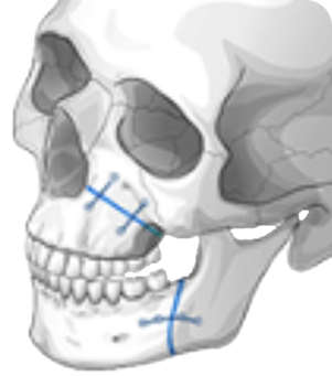 id Hospital - Male Orthognathic Surgery - Natural Bite Correction Through Joint Stabilization