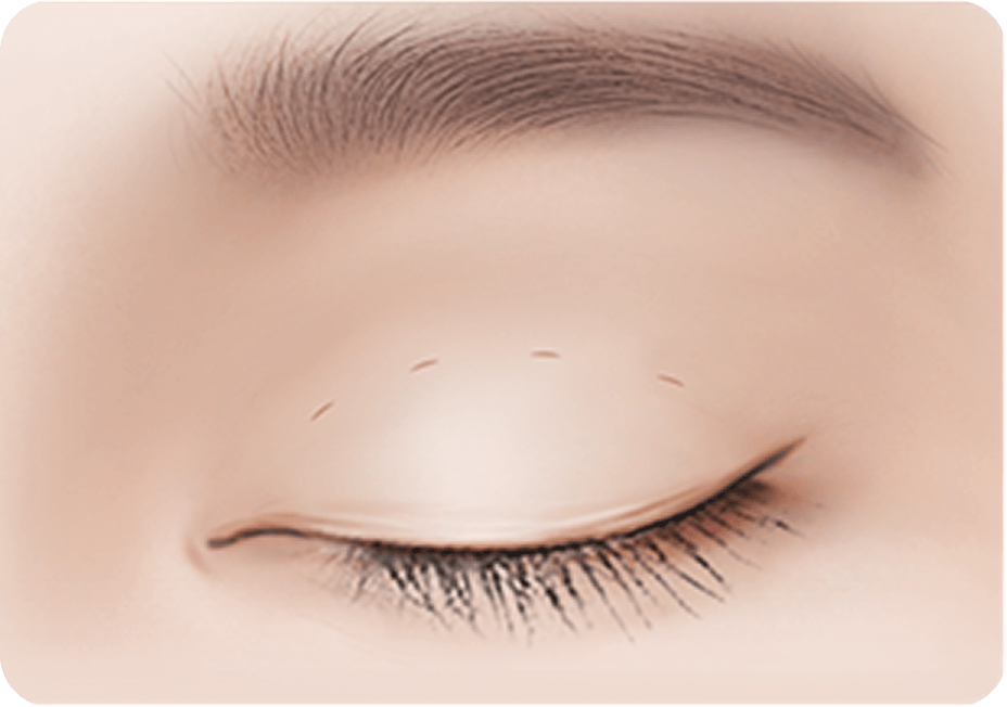 id Hospital - Male Ptosis Correction - Natural Adhesion Double Eyelid