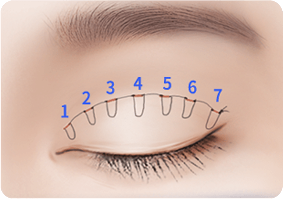 id Hospital - Male Ptosis Correction - Fixed at 7 Points