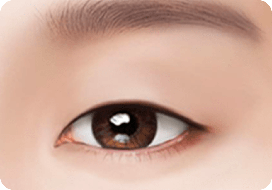 id Hospital - Male Ptosis Correction - Incisional Double Eyelid Step 1