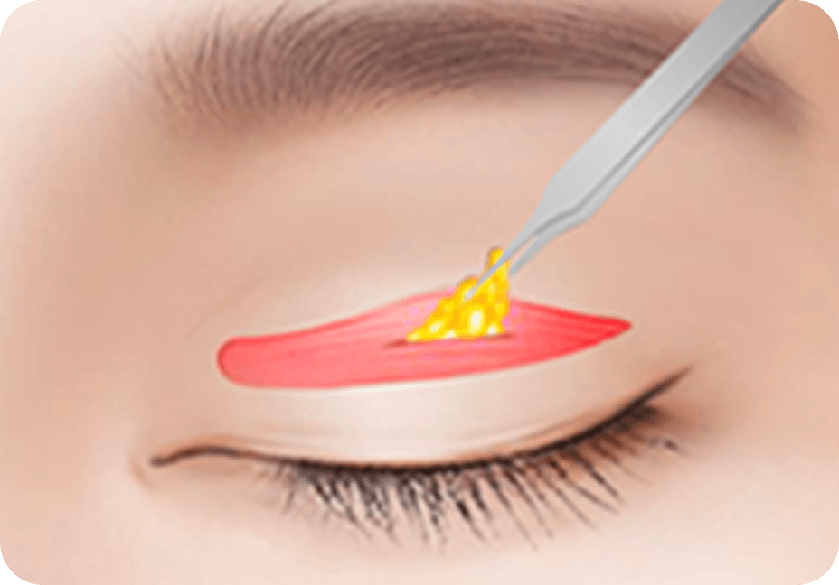 id Hospital - Male Ptosis Correction - Incisional Double Eyelid Step 2