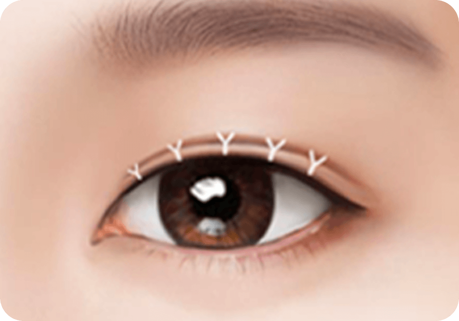 id Hospital - Male Ptosis Correction - Incisional Double Eyelid Step 3