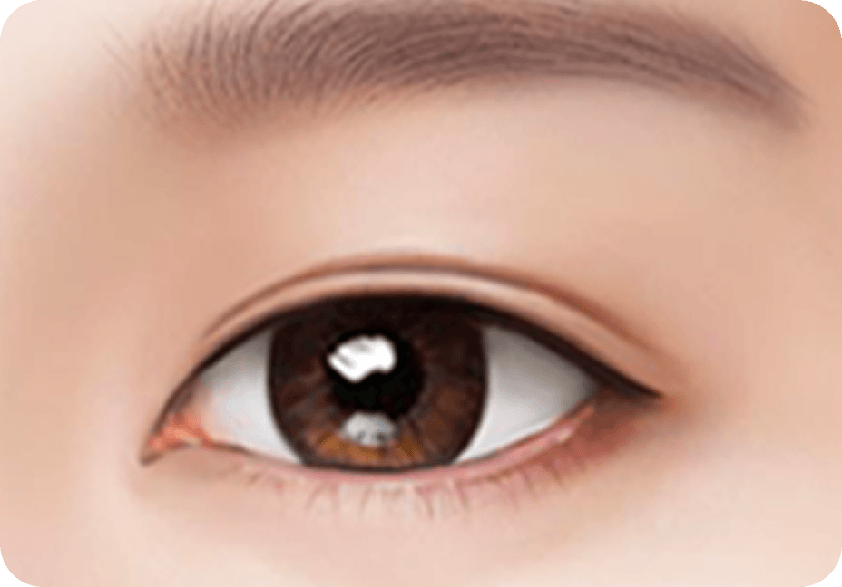 id Hospital - Male Ptosis Correction - Incisional Double Eyelid Step 4