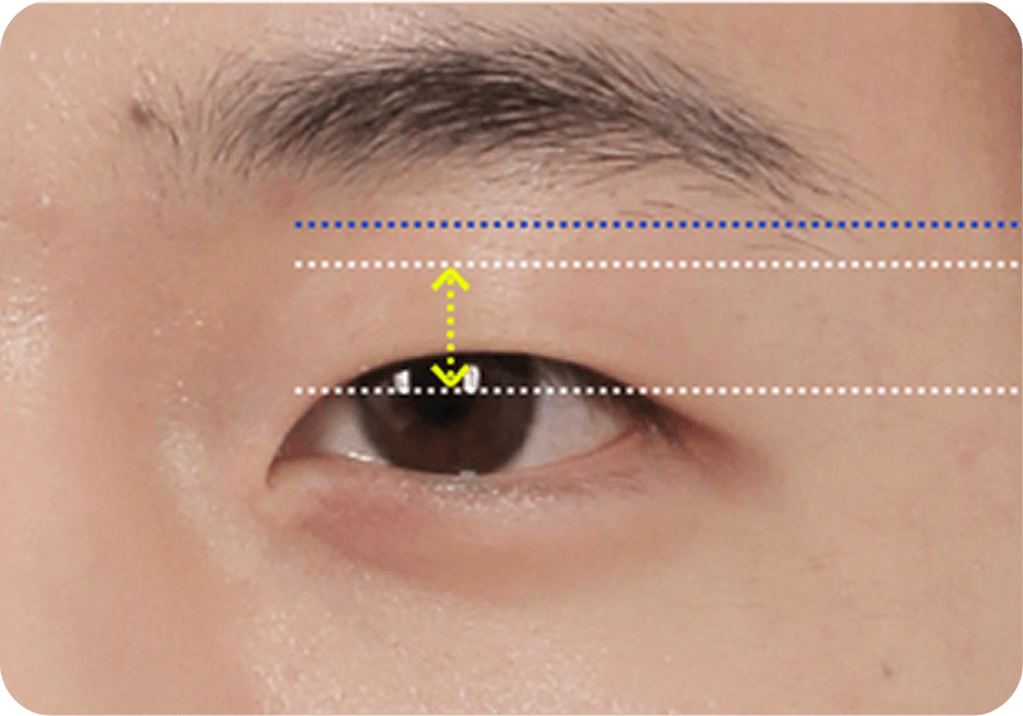 id Hospital - Male Ptosis Correction - Monolid Eye Correction Before Surgery