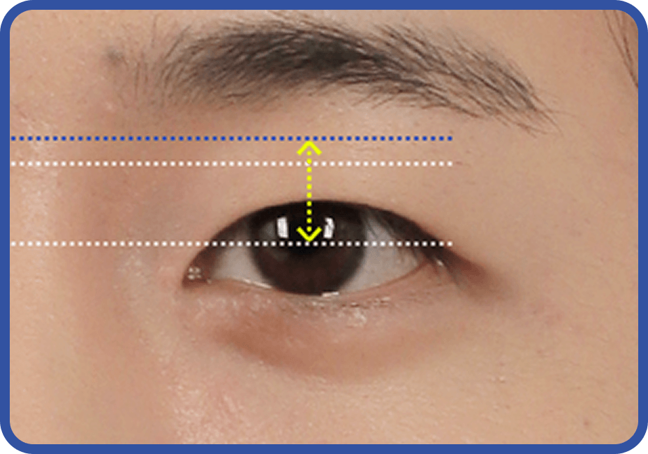 id Hospital - Male Ptosis Correction - Monolid Eye Correction After Surgery