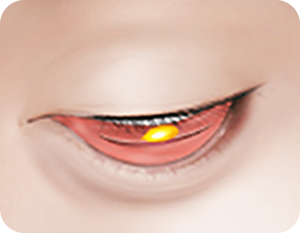 id Hospital - Male Ptosis Correction - Under-Eye Surgery STEP 1