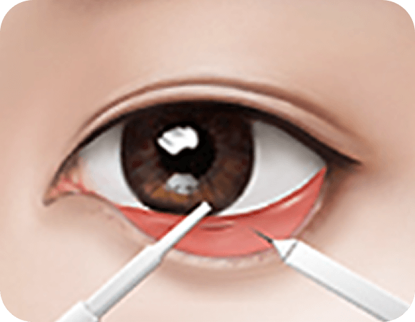 id Hospital - Male Ptosis Correction - Under-Eye Surgery STEP 2