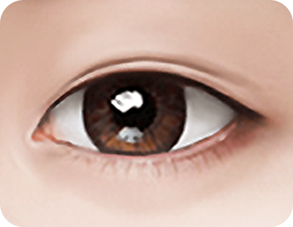 id Hospital - Male Ptosis Correction - Under-Eye Surgery STEP 3