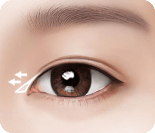 id Hospital - Male Ptosis Correction - Epicanthoplasty