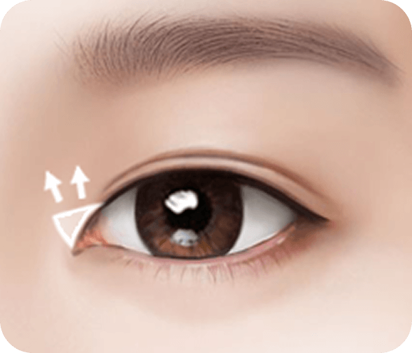 id Hospital - Male Ptosis Correction - Upper Canthoplasty