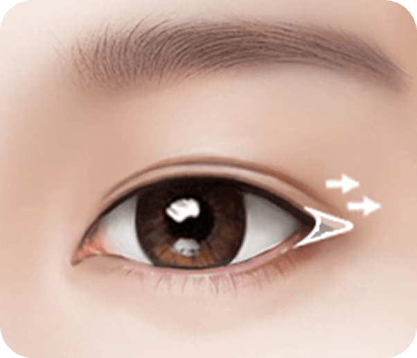 id Hospital - Male Ptosis Correction - Lateral Canthoplasty