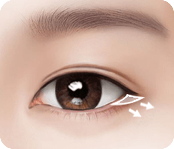 id Hospital - Male Ptosis Correction - Lower Canthoplasty