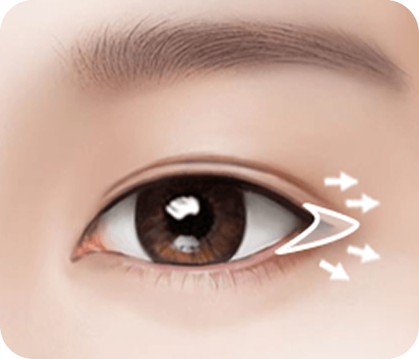 id Hospital - Male Ptosis Correction - Dual Canthoplasty